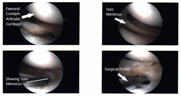 Imágenes artroscópicas intraoperatorias de la rodilla izquierda 2 Imágenes artroscópicas intraoperatorias de la rodilla izquierda 2