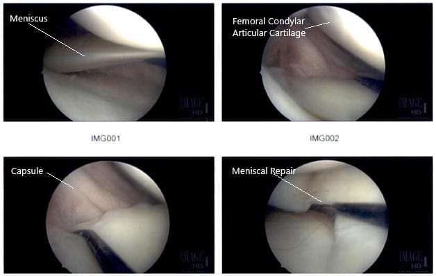 Imágenes artroscópicas intraoperatorias de la rodilla derecha