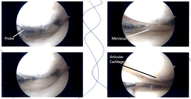 Intraoperative Arthroscopy images Intraoperative Arthroscopy images