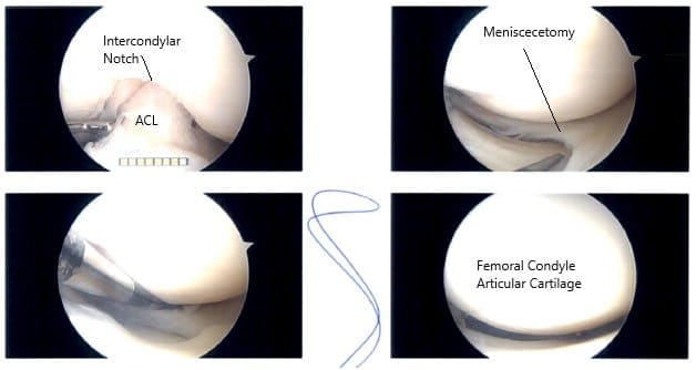 Intraoperative Arthroscopy images 2 Intraoperative Arthroscopy images 2