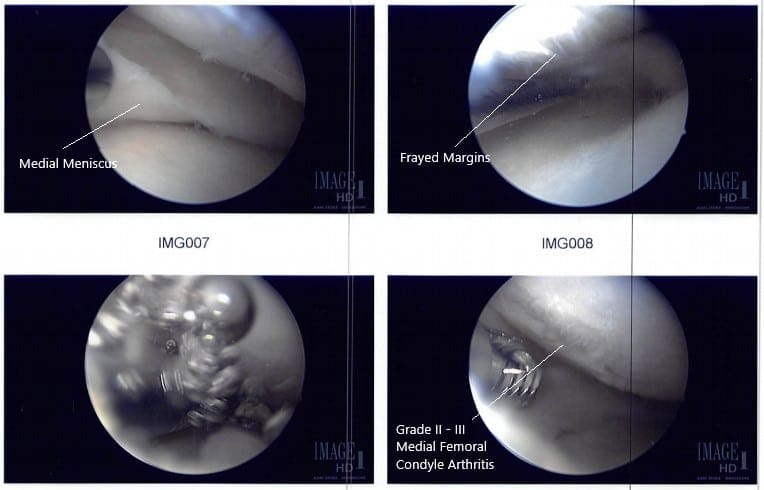 Imágenes intraoperatorias con artroscopio 2