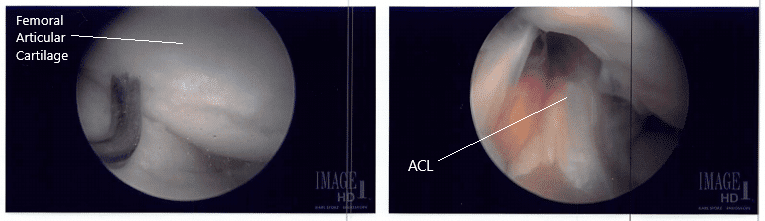 Imágenes intraoperatorias con artroscopio 3