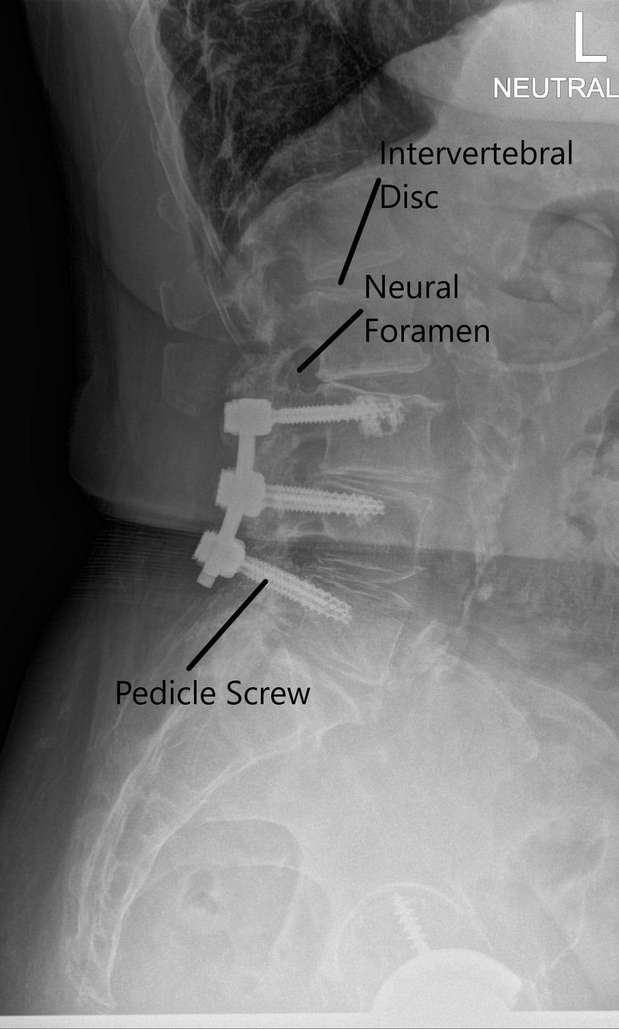 Radiografía de la columna vertebral del LS en vistas AP y laterales 2 Radiografía de la columna vertebral del LS en vistas AP y laterales 2
