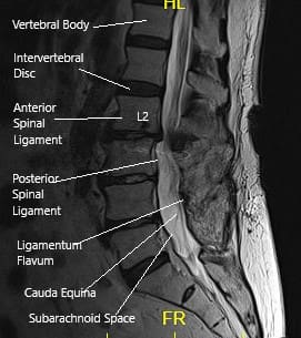 Resonancia magnética de la columna LS en la sección sagital Resonancia magnética de la columna LS en la sección sagital