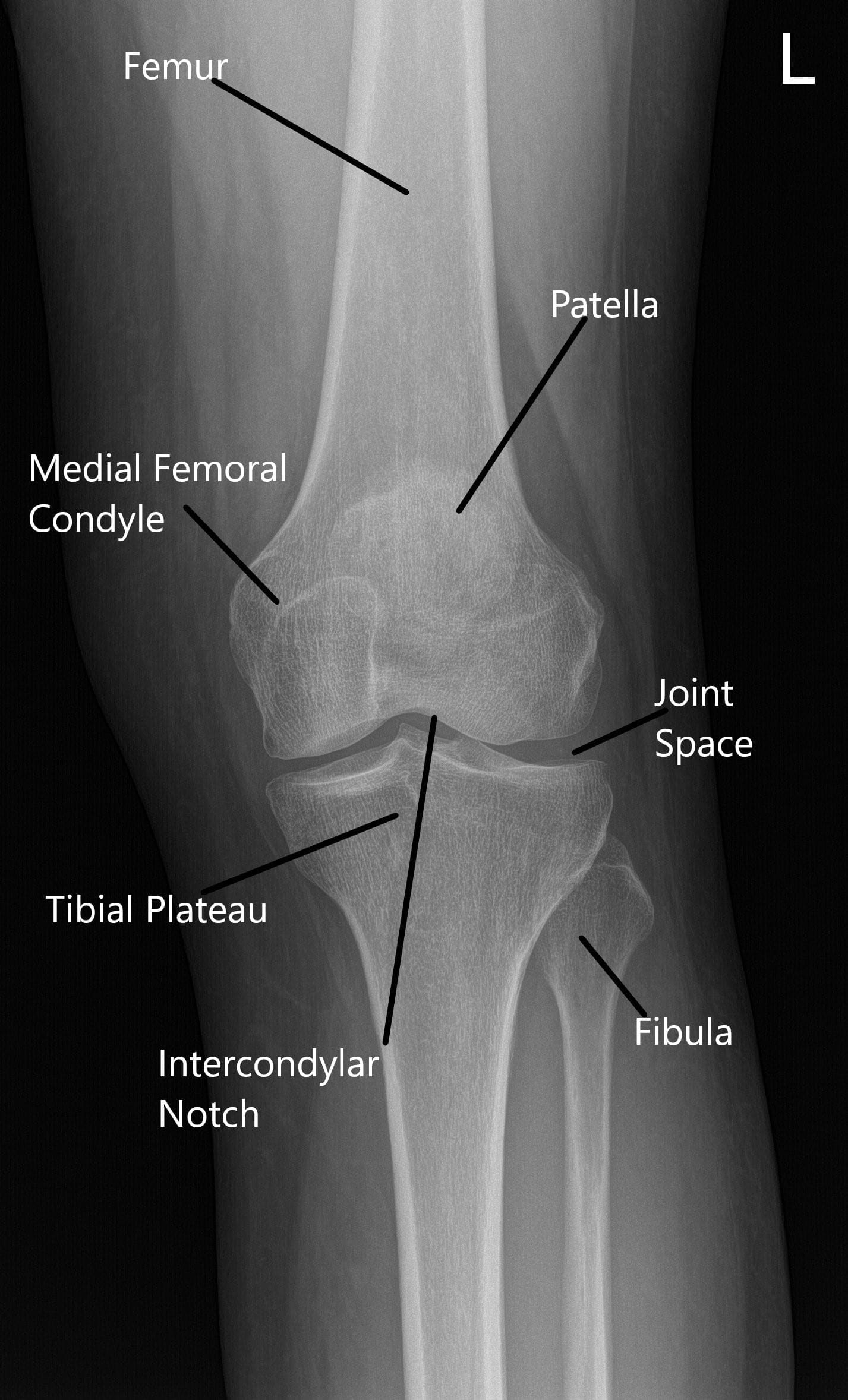 Normal X-ray of the knee joint showing the various structures in the Anteroposterior and Lateral view Normal X-ray of the knee joint showing the various structures in the Anteroposterior and Lateral view
