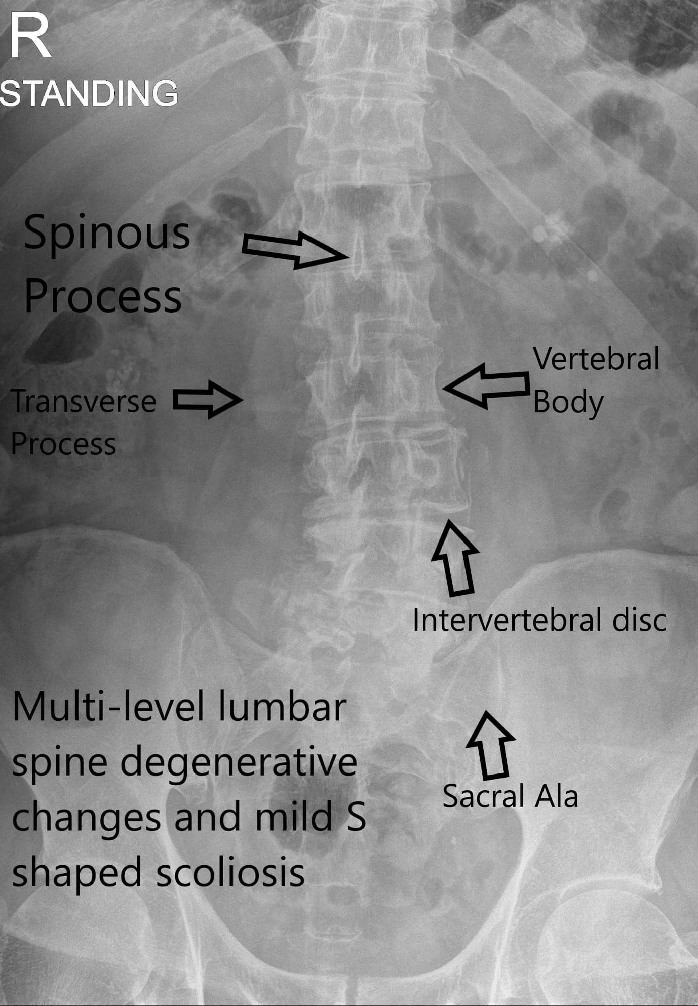 Vista AP de la columna vertebral de rayos X LS Vista AP de la columna vertebral de rayos X LS