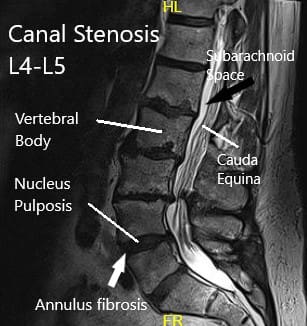 Resonancia magnética de la columna lumbar Resonancia magnética de la columna lumbar