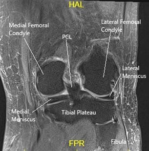 Resonancia magnética de la rodilla en corte coronal mostrando diversas estructuras Resonancia magnética de la rodilla en corte coronal mostrando diversas estructuras