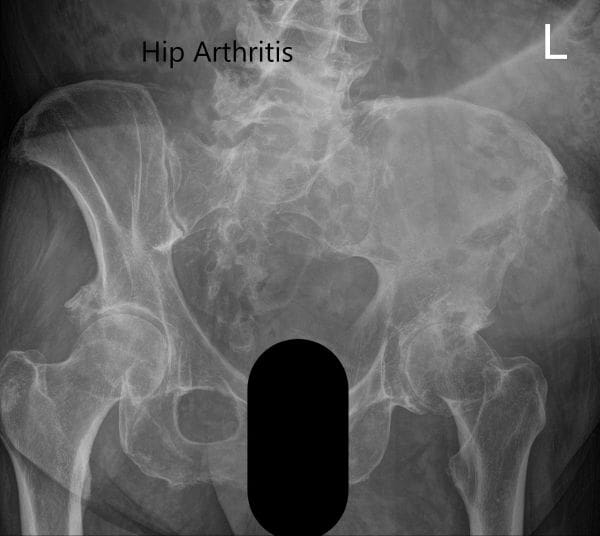 Preoperative X-ray showing the frog-legged lateral and AP view of the left hip 2 Preoperative X-ray showing the frog-legged lateral and AP view of the left hip 2