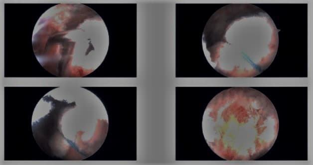 Imágenes artroscópicas intraoperatorias Imágenes artroscópicas intraoperatorias