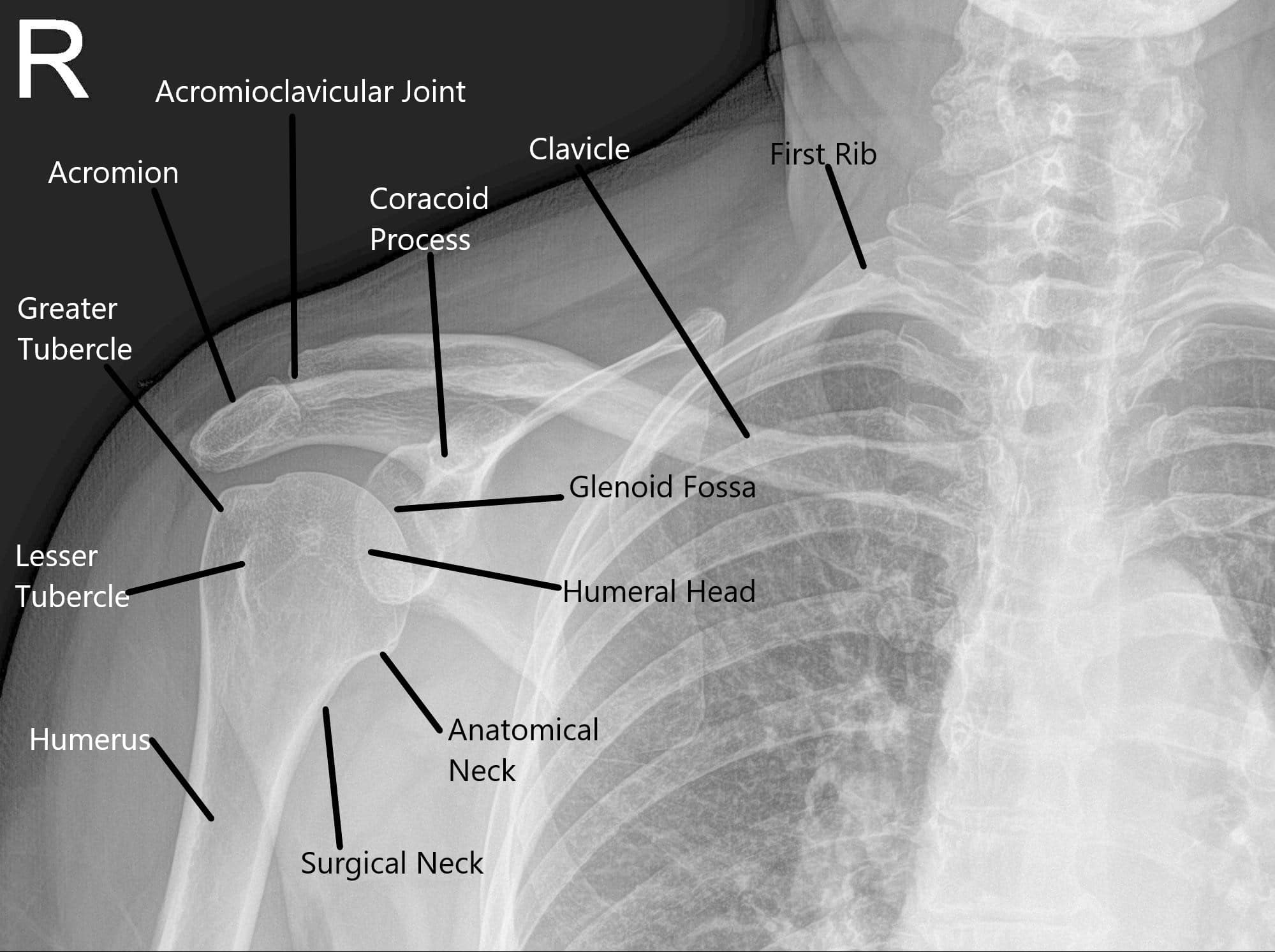 Radiografía que muestra la anatomía normal del hombro Radiografía que muestra la anatomía normal del hombro