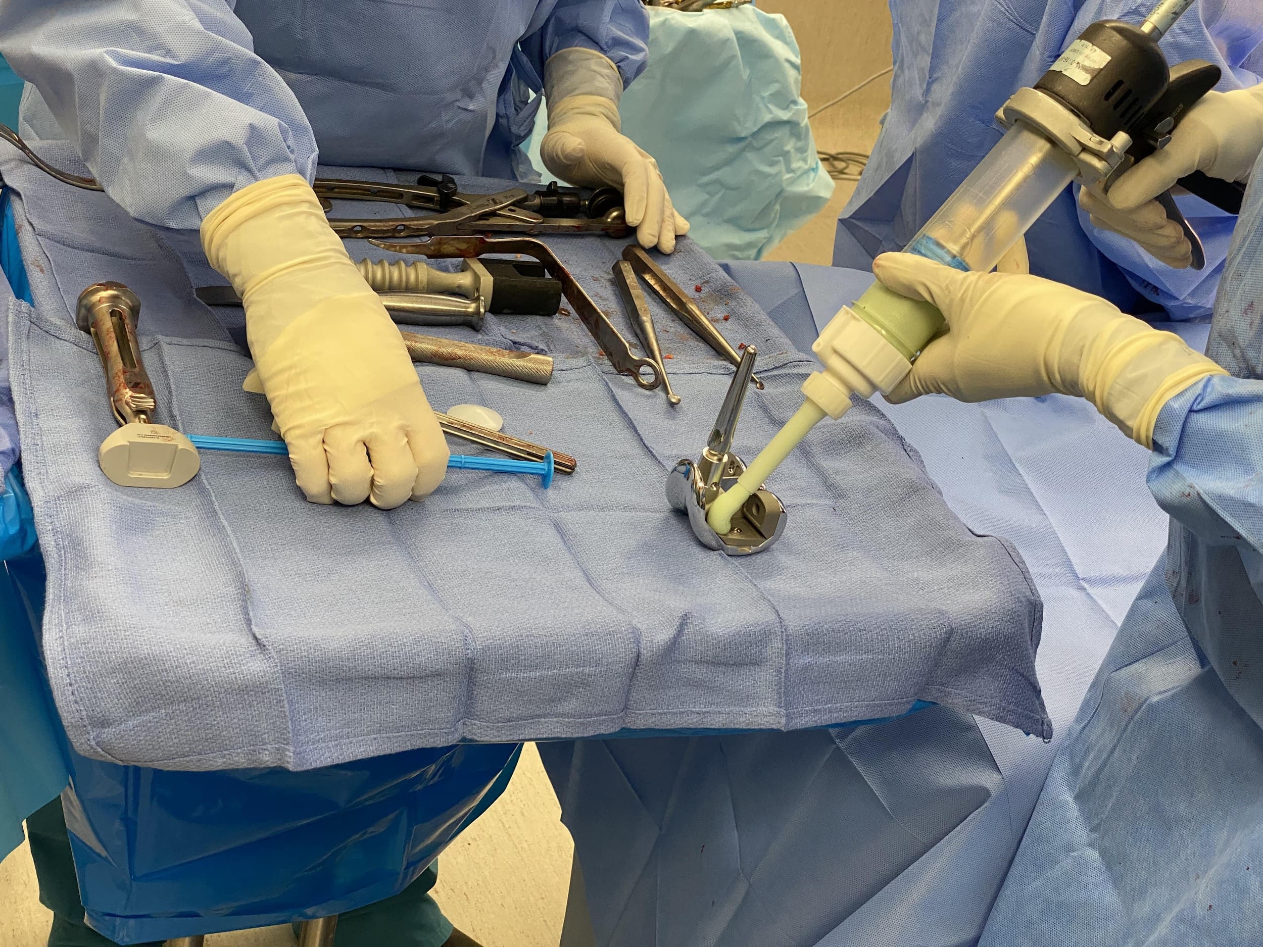 Cementing of the femoral component Cementing of the femoral component