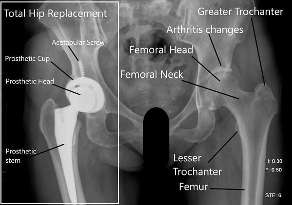Hip x-ray