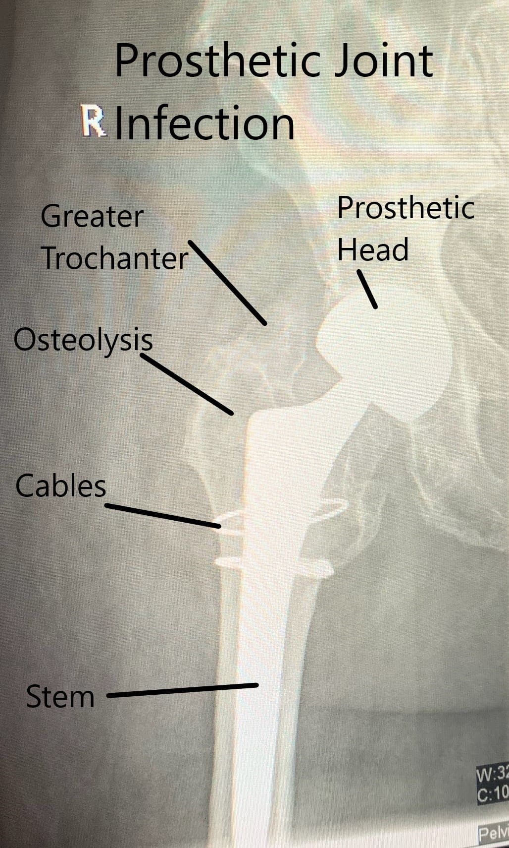 Radiografía que muestra infección de la articulación protésica Radiografía que muestra infección de la articulación protésica