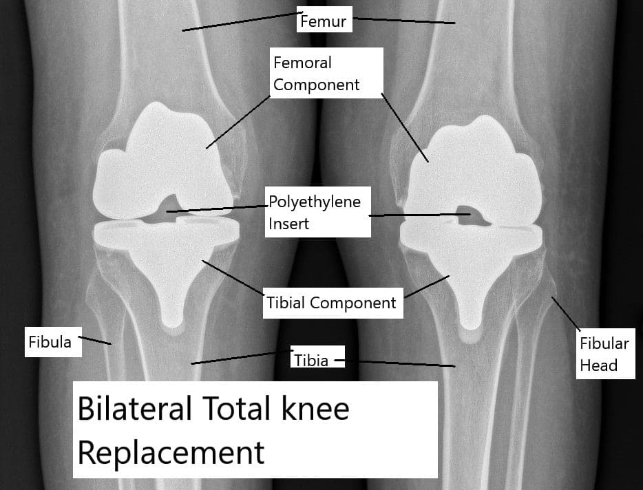 Reemplazo total de rodilla en ambas rodillas.
