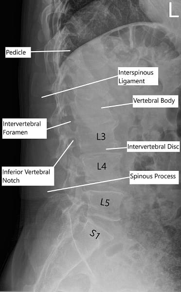 Radiografía de la columna lumbar en vista lateral