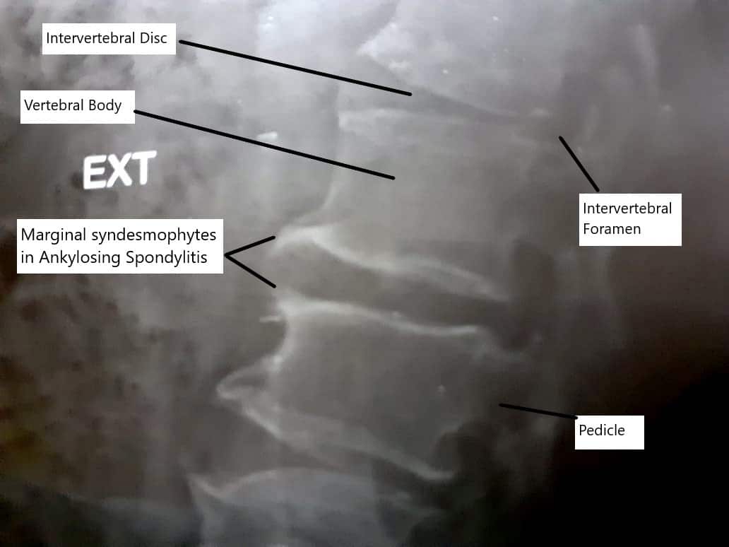 Sindesmofitos en la espondilitis anquilosante