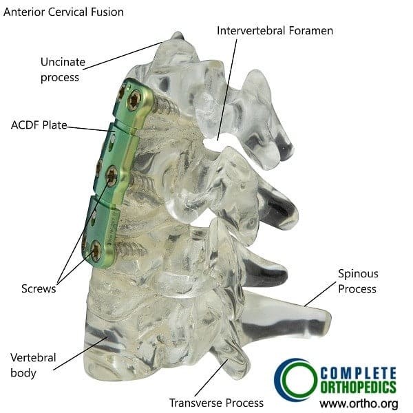La fusión cervical anterior puede realizarse en casos graves de artritis e inestabilidad de la columna cervical resultante de artritis idiopática juvenil