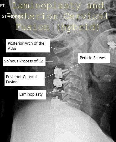 AP and Lateral view X-ray Post-op Laminoplasty and Posterior Spinal Fusion