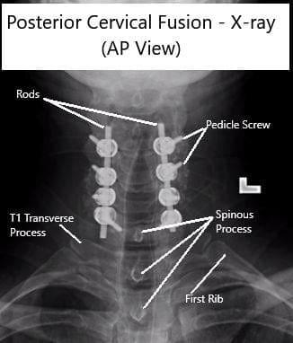 AP and Lateral View X-rays of Posterior Cervical Laminectomy and Fusion AP and Lateral View X-rays of Posterior Cervical Laminectomy and Fusion