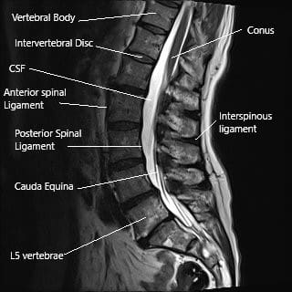 Resonancia magnética de la columna lumbar que muestra el ligamento interespinoso y el proceso espinoso.