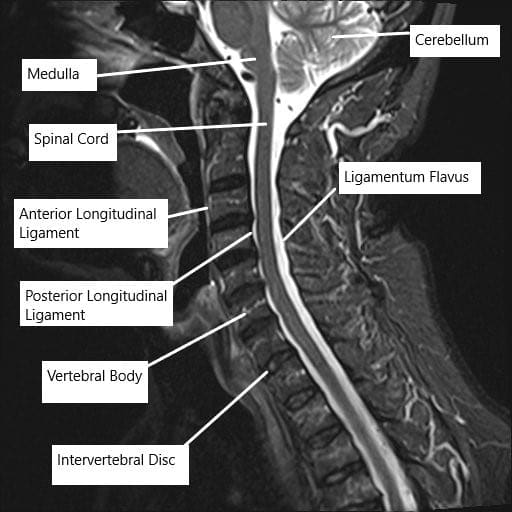 Resonancia magnética de la columna cervical que muestra los distintos ligamentos que rodean la médula espinal.