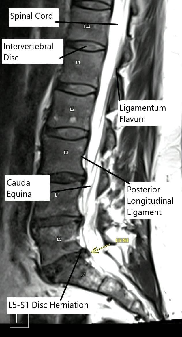 Sección sagital de la resonancia lumbar que muestra hernia discal L5-S1.