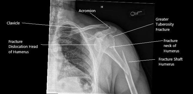 Radiografía preoperatoria del hombro izquierdo en vista AP.