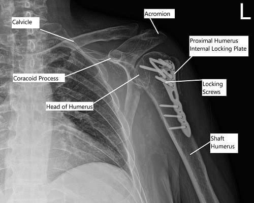 Radiografía postoperatoria del hombro izquierdo en vista AP.