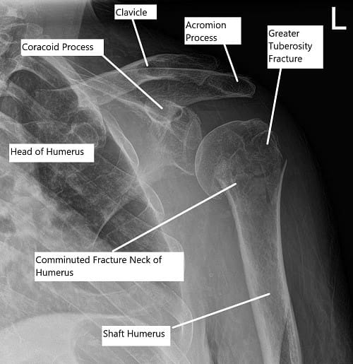 Radiografía preoperatoria del hombro que muestra una fractura en tres partes del húmero proximal.