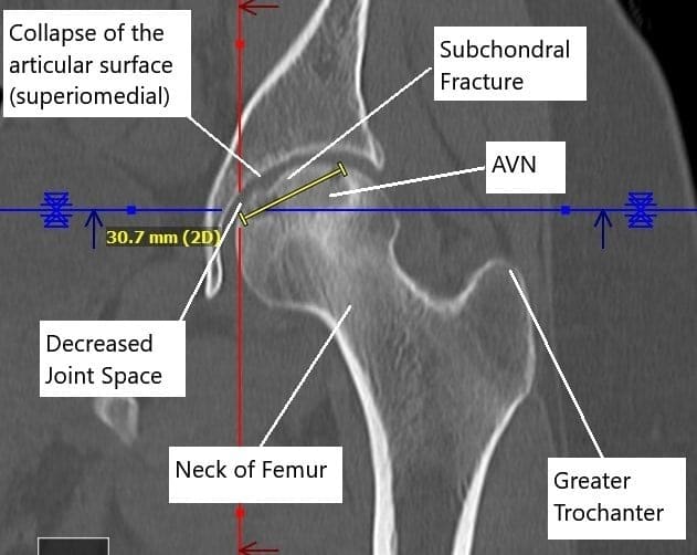 Non-contrast CT image showing AVN changes in the left head of the femur. Non-contrast CT image showing AVN changes in the left head of the femur.