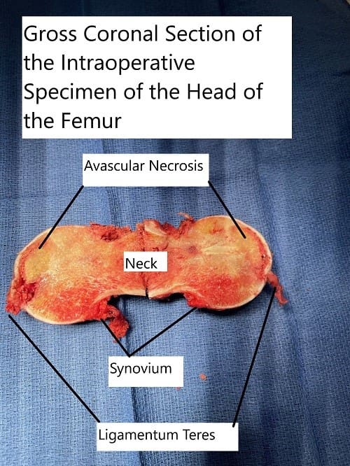 Intraoperative extracted head of the femur with a coronal cut section showing the avascular necrotic area in the superior medial head. Intraoperative extracted head of the femur with a coronal cut section showing the avascular necrotic area in the superior medial head.