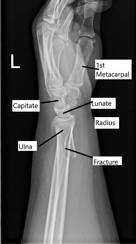 Radiografía que muestra fractura distal del radio en vista lateral.