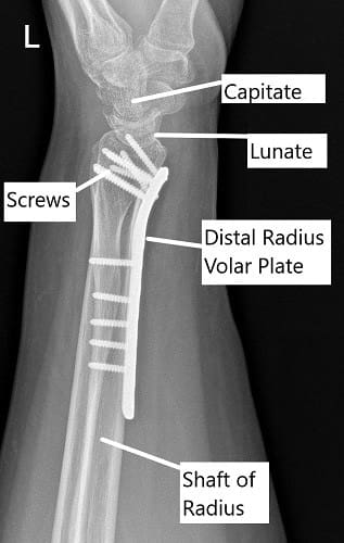 Radiografía postoperatoria de la muñeca en vista lateral.