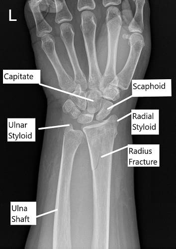 Radiografía que muestra fractura distal del radio en vista AP.