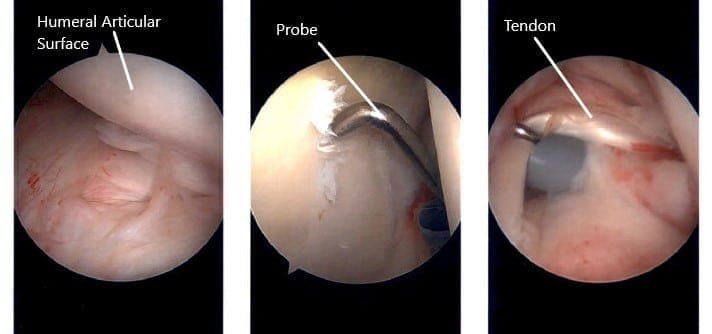 Imágenes artroscópicas intraoperatorias del hombro izquierdo.