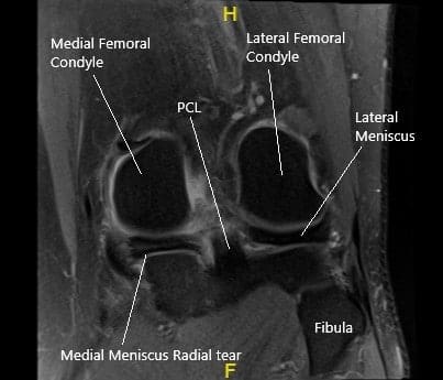 Resonancia magnética de la rodilla izquierda en la sección coronal que muestra el menisco medial desgarrado.