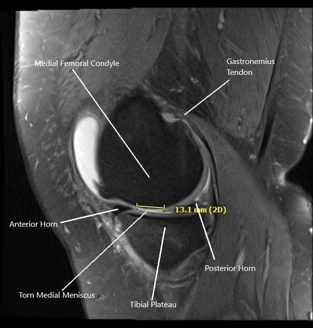 Resonancia magnética de la rodilla derecha en la sección sagital que muestra desgarro del menisco medial.