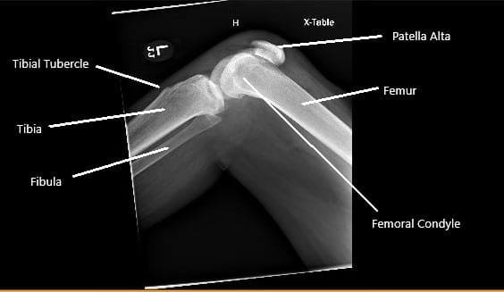 Radiografía de la rodilla derecha que muestra rótula alta secundaria a la ruptura del tendón rotuliano.