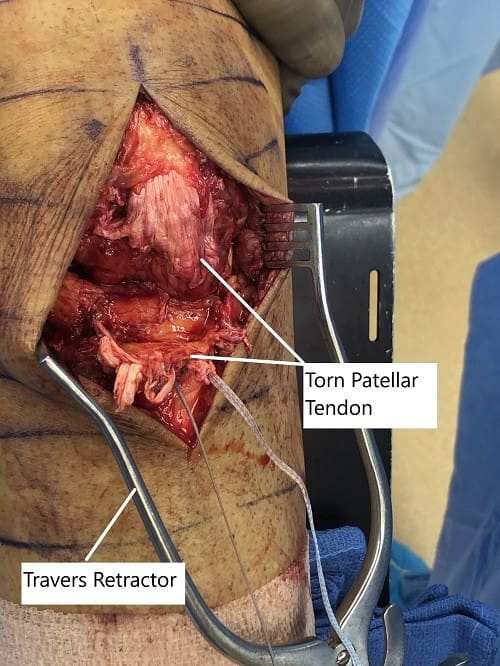 Imagen intraoperatoria que muestra el tendón rotuliano desgarrado.