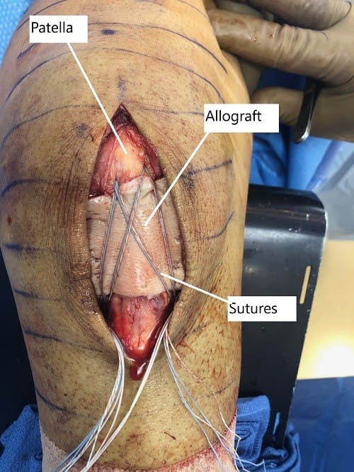 Imagen intraoperatoria que muestra el tendón rotuliano reparado con aloinjerto suprayacente.