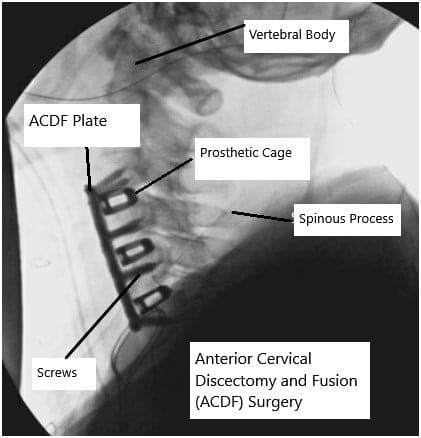 Radiografía que muestra cirugía ACDF.