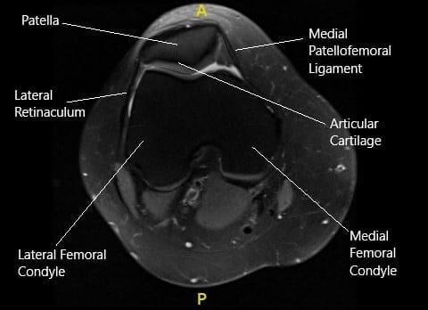 Resonancia magnética de la rodilla derecha en la sección axial.