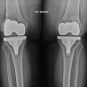 joint-replacement-xray