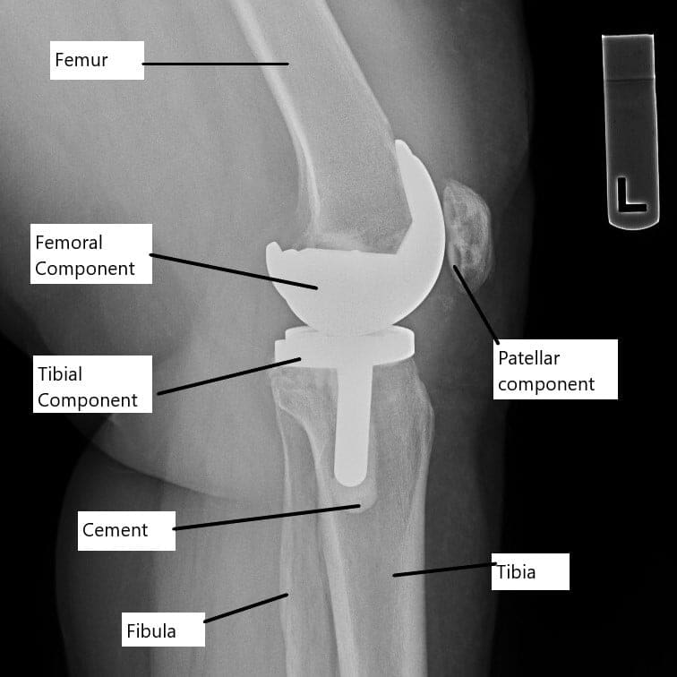 La radiografía muestra un reemplazo total de rodilla.