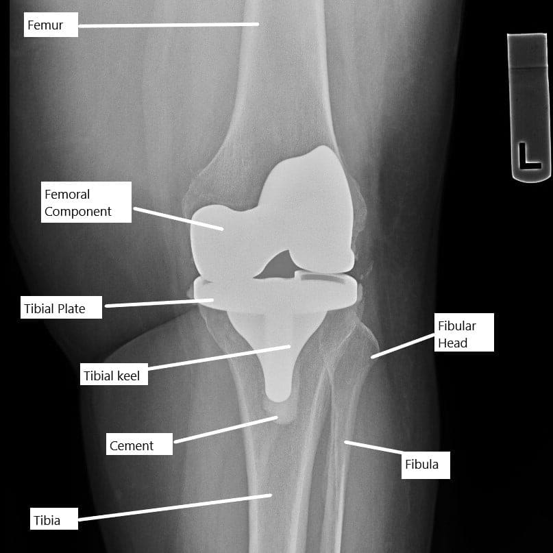 Radiografía de una prótesis total de rodilla.