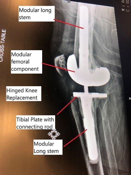 Imagen fluoroscópica intraoperatoria que muestra un reemplazo modular de rodilla de revisión.