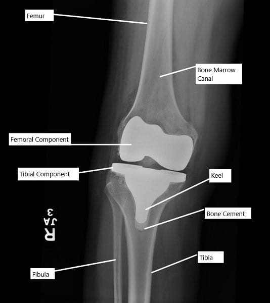 Radiografía de una prótesis total de rodilla.