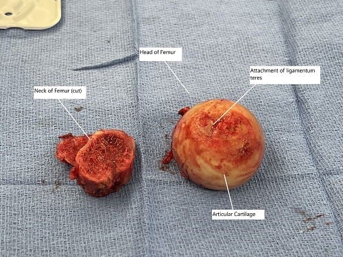 Intraoperative image showing the removed head of the femur and the neck of the femur.