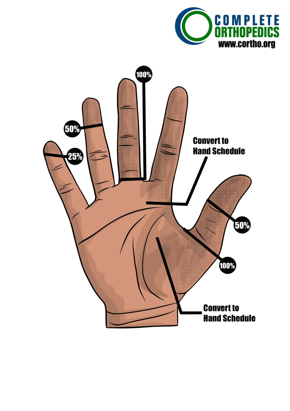 Amputation of fingers to evaluate loss of motion to calculate scheduled loss of use for workers compensation patient